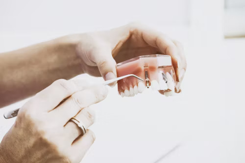 Transform Your Smile with Veneers Birmingham, Dental Implants Solihull, and Clear Braces Solihull