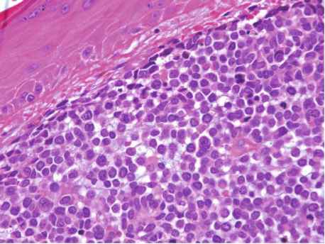 Merkel Cell Carcinoma Market Is Anticipated To Witness High Growth Owing To Rising Incidence Of Merkel Cell Carcinoma