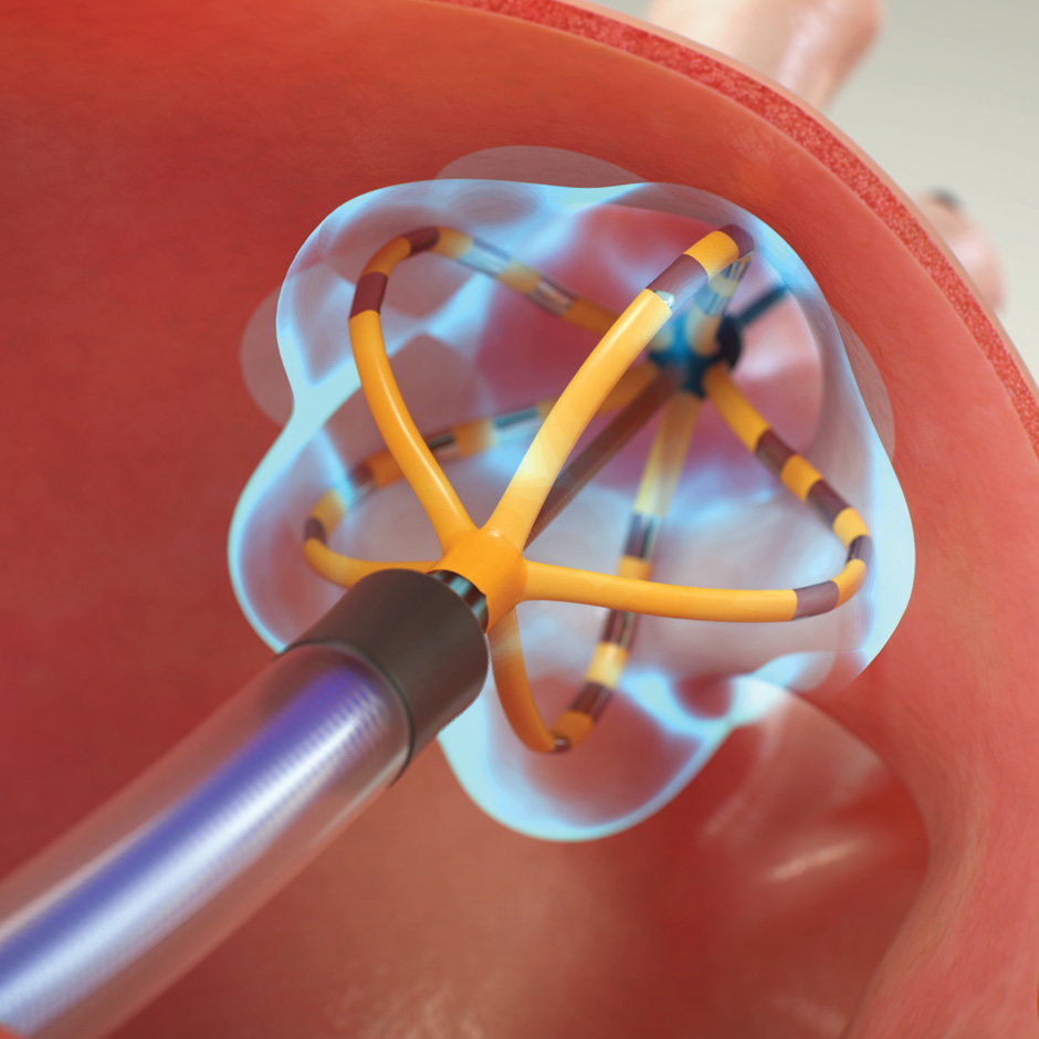  The Pulsed Field Ablation Market Is Anticipated To Witness High Growth Owing To Rising Prevalence Of Cardiac Arrhythmias