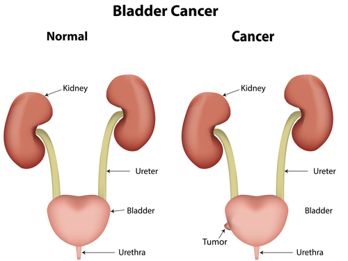 Bladder Cancer Treatment in India | Healing Touristry