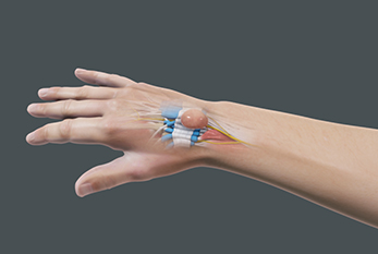 Ganglion Cyst Excision | Healing Touristry