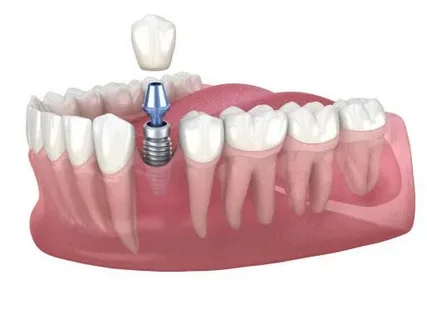 Do You Have Stitches with Dental Implants?