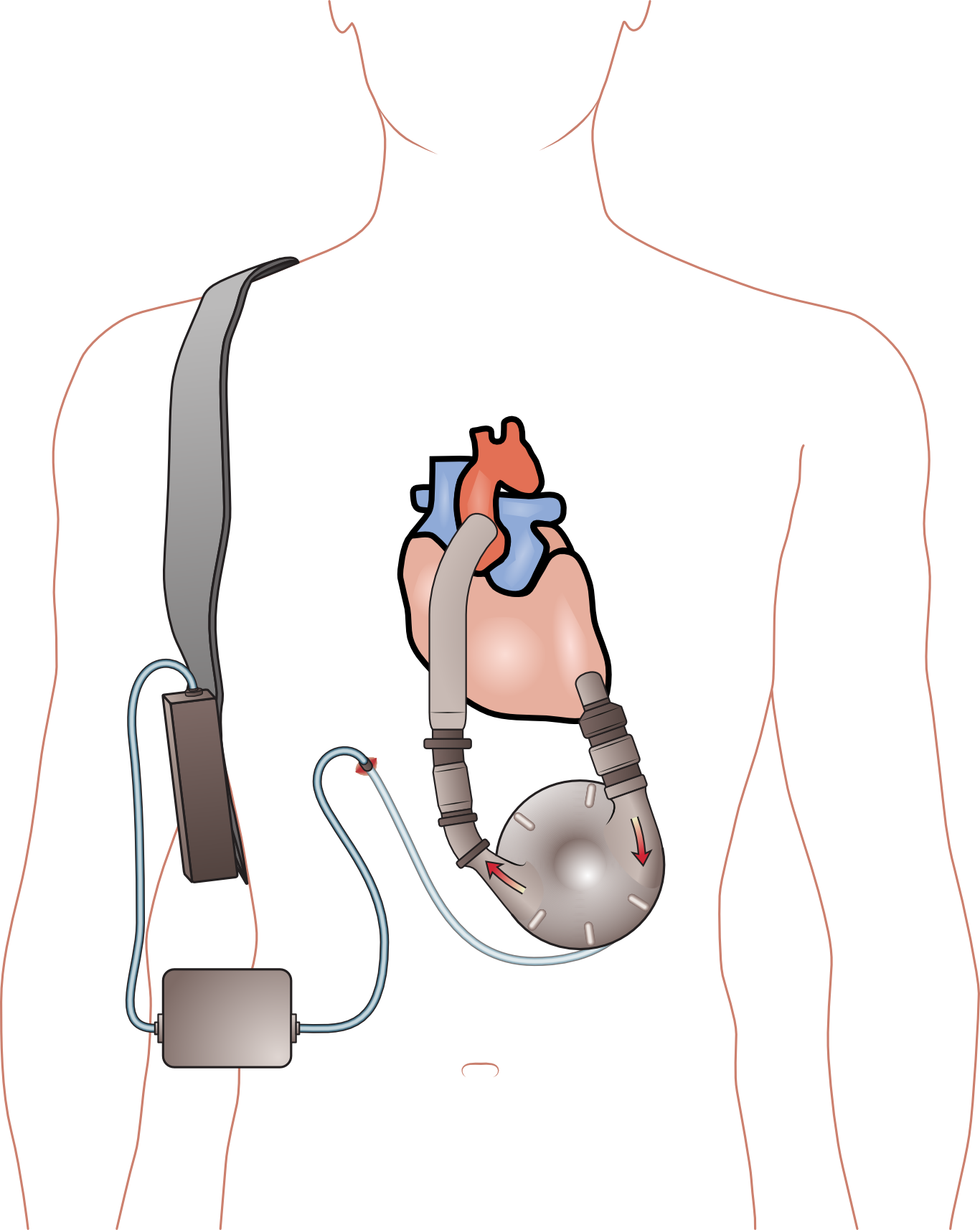 Congestive Heart Failure Treatment Devices Market Size Trends, Growth, and Outlook 2024-2033