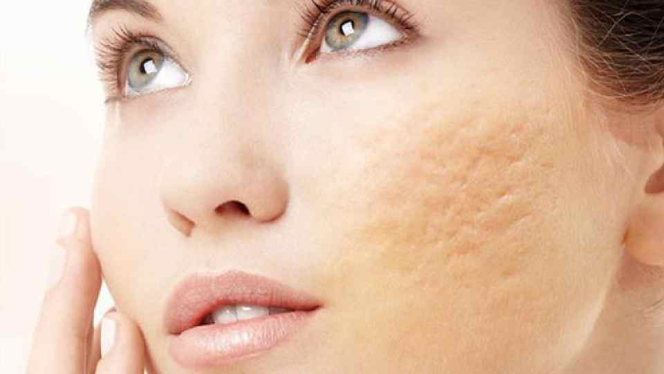 Scar Removal Market Latest Techniques, Upcoming Trends and Developments Till 2023