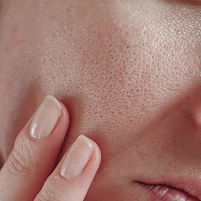 Can Laser Procedures Safely Minimize Enlarged Facial Pores?