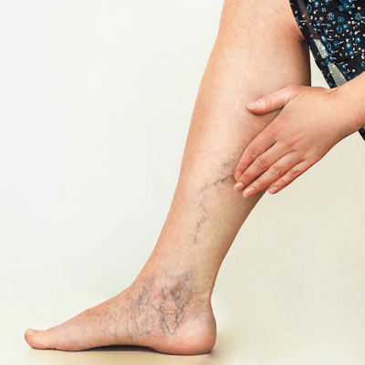 What Is the Typical Cost of Varicose Vein Treatment?