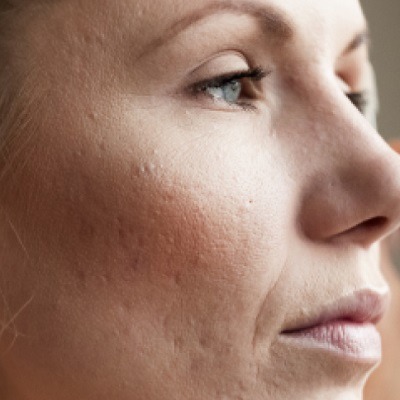 Can Laser Procedures Safely Minimize Enlarged Facial Pores?