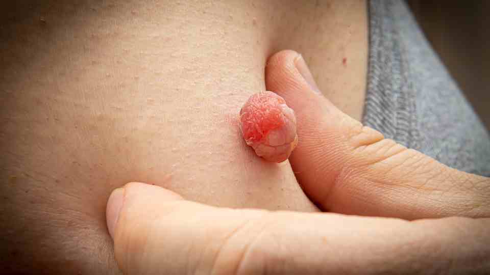 Can Children Safely Undergo Skin Tag Removal Procedures?