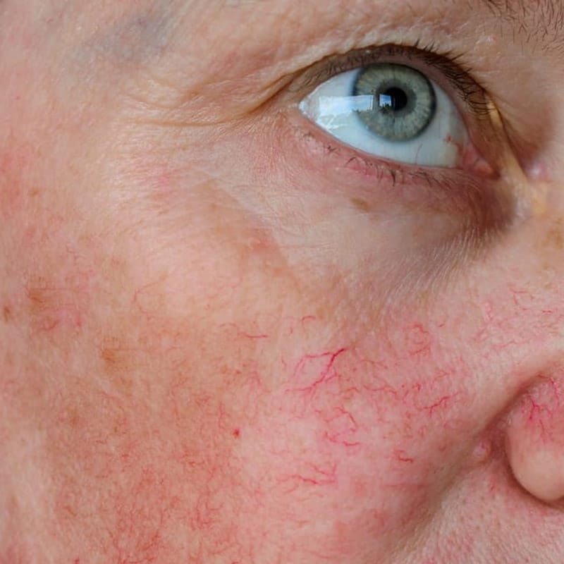 Can Facial Capillary Treatment Help Manage Rosacea?