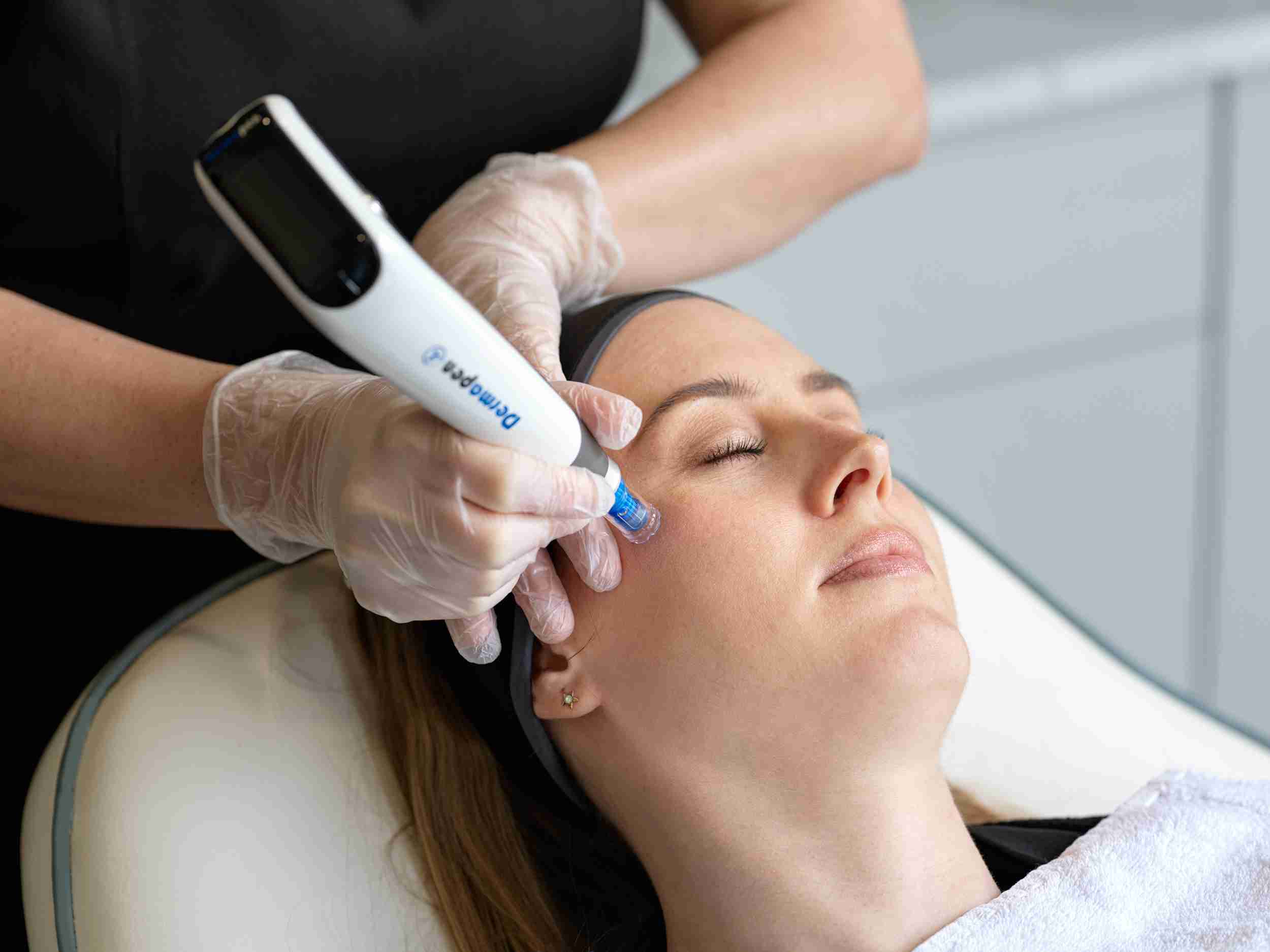 What Is the Cost of Dermapen Treatment?