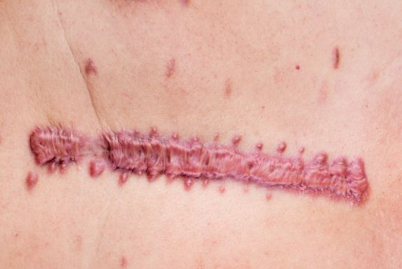 Do Hypertrophic Scars Commonly Form on Specific Body Areas?
