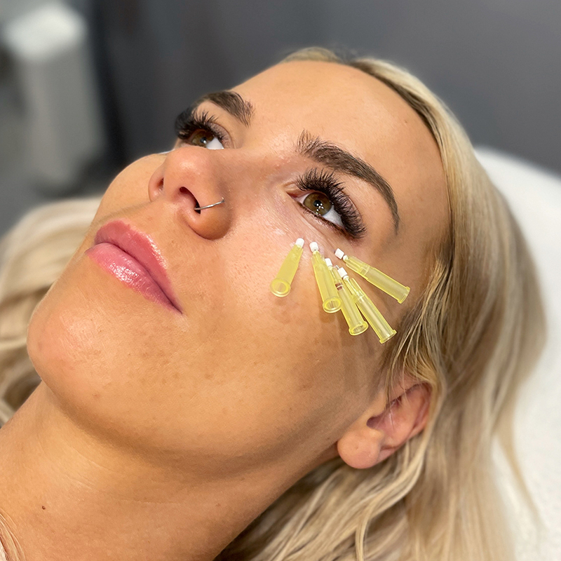 Are PDO Mono Threads Effective for Enhancing Skin Tightness?