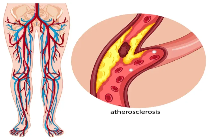 What’s the Connection Between Peripheral Artery Disease, Diabetes, and Gangrene?