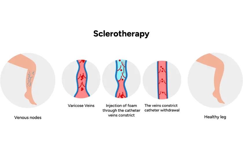Sclerotherapy vs Laser Treatment for Spider Veins: Which Is Better? 
