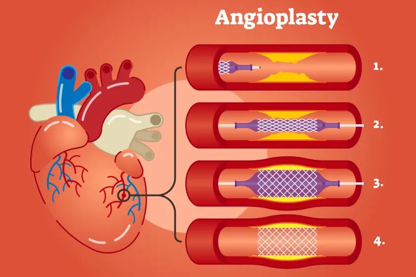 Leg Bypass Surgery vs Angioplasty: Which Treatment Is Better for Blocked Leg Arteries?