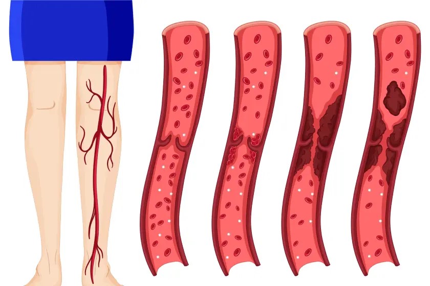 Role of Endovascular Treatment in Managing Aneurysms and Arterial Blockages