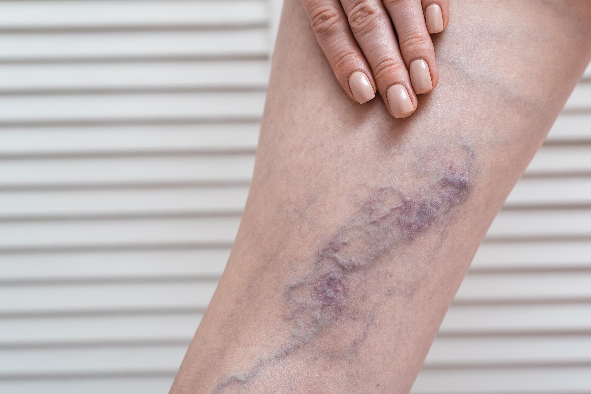 Top Varicose Vein Home Remedies to Relieve Leg Discomfort Naturally