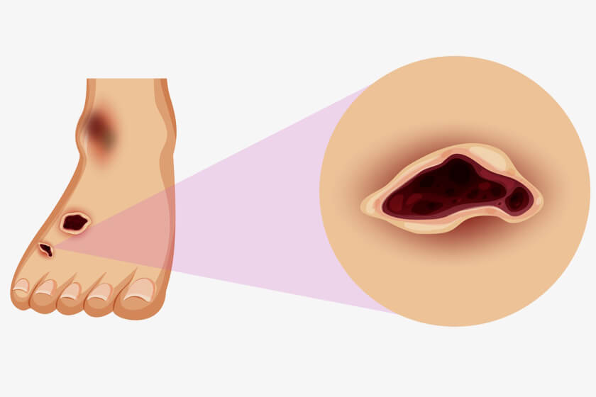 Foot and Toe Ulcers: Treatment, Prevention, Repair and Causes