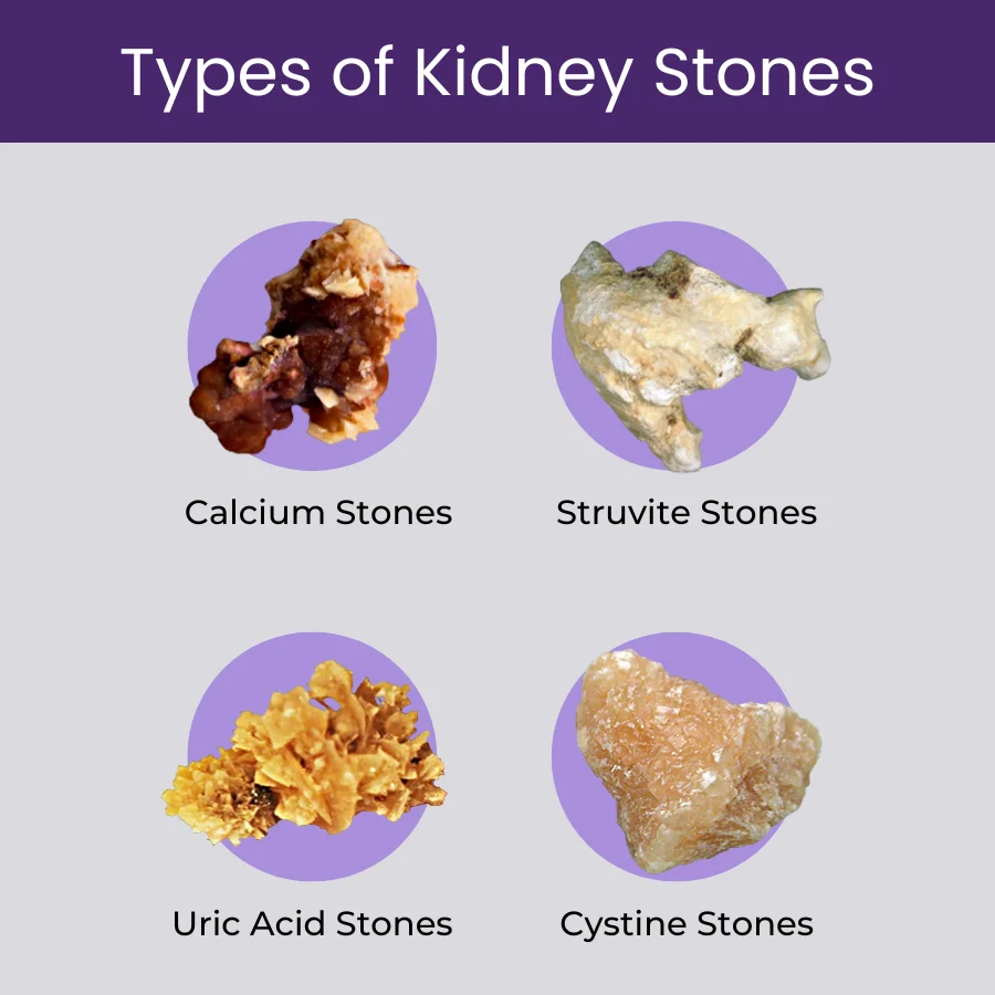 What are the different types of urinary stones, and how does Dr Abhijit Gokhale determine the most effective treatment for each type?