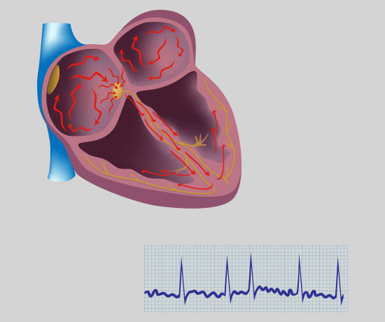 Atrial Fibrillation Market Size, In-depth Analysis Report and Global Forecast to 2032