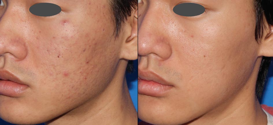 How Microneedling Can Transform Acne Scars in Toronto