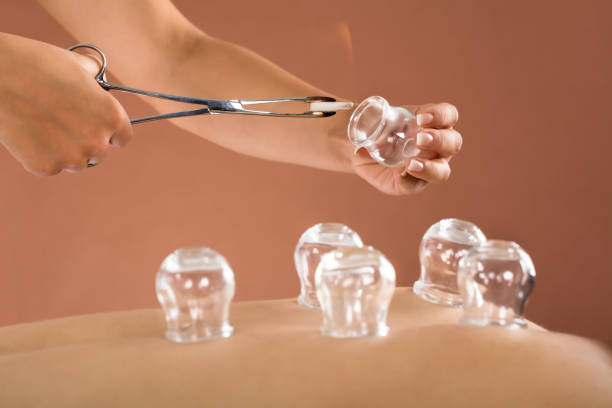 Exploring Cupping Therapy: What to Expect and How It Works