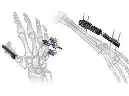 External Fixators Market is Poised for Growth Owing to Rising Trauma Cases