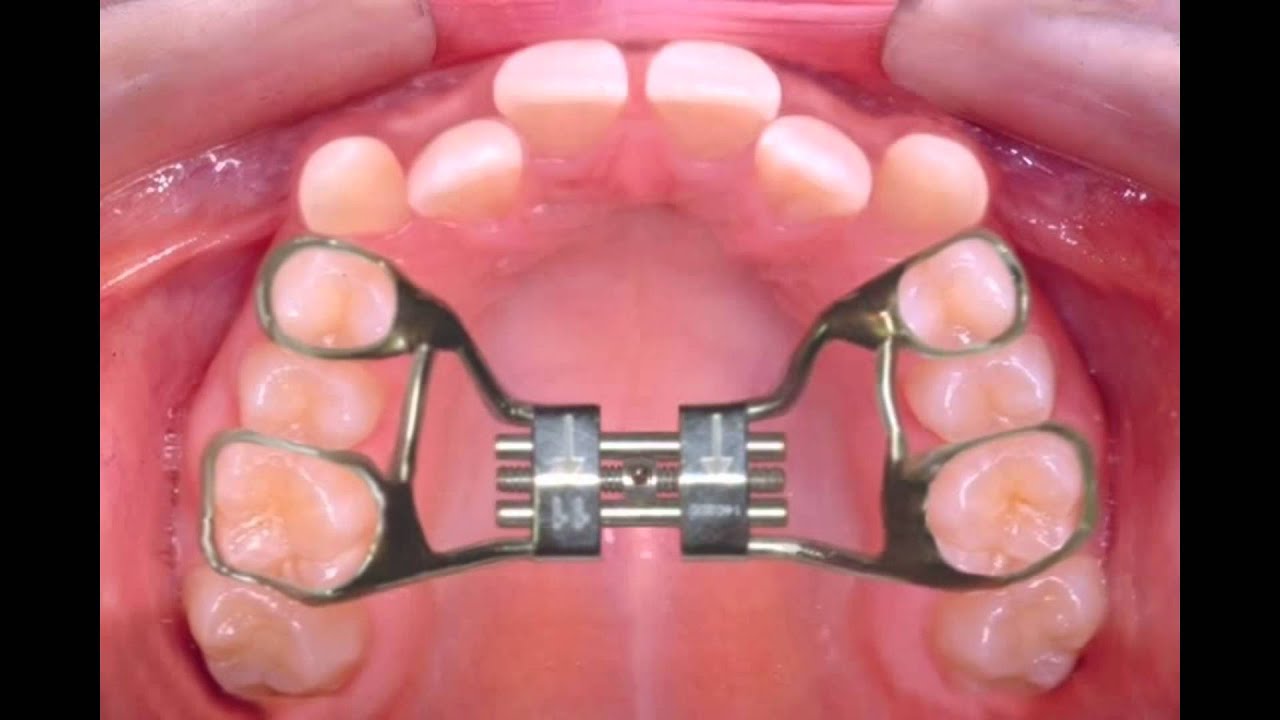 Plasma Expanders: Solution for Managing Hypovolemia 