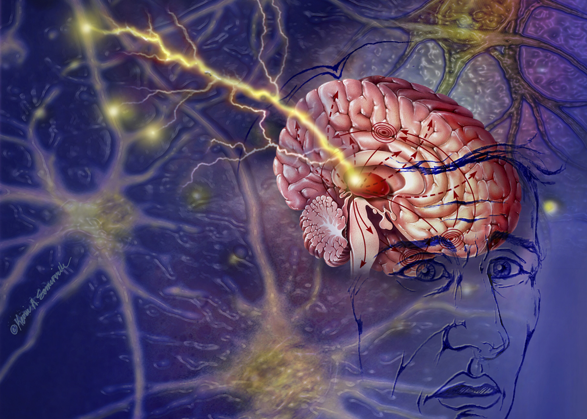 Acute Repetitive Seizures: Unraveling the Mysteries of Acu Repetitive Seizures New Insights