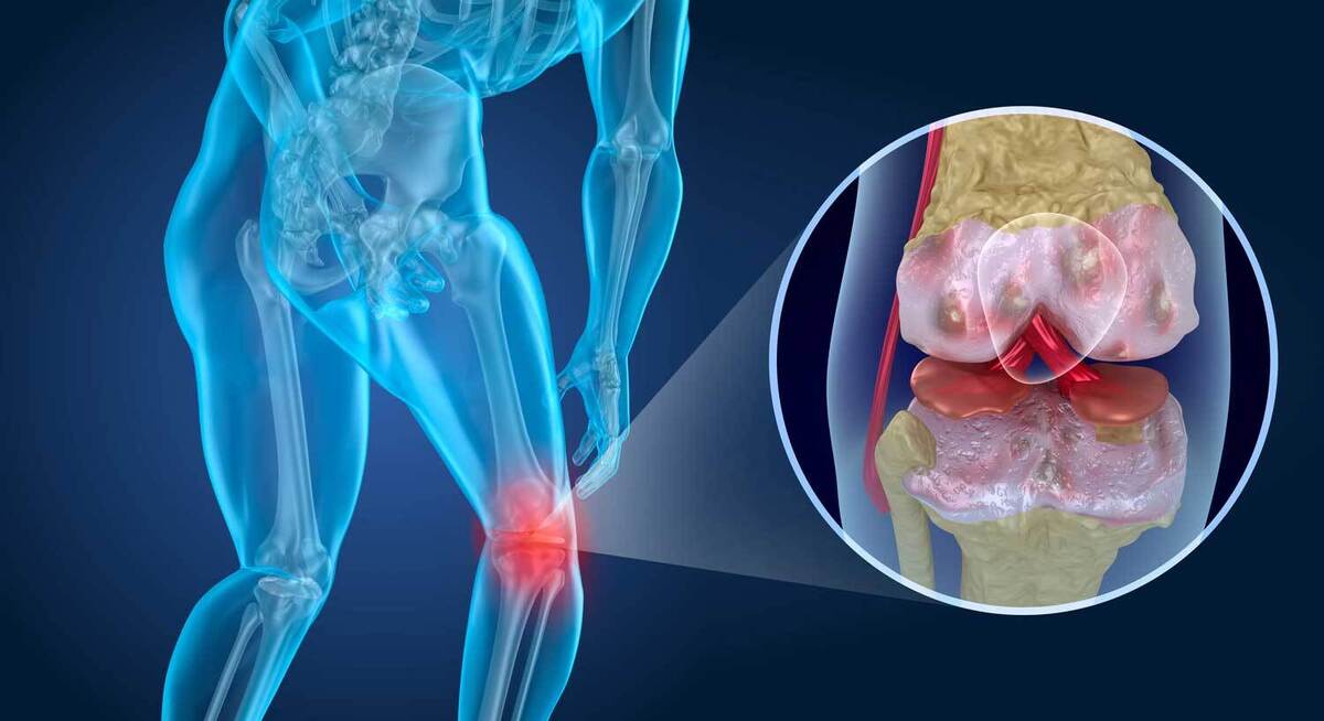 Cartilage Degeneration Market 2023 Major Key Players and Industry Analysis Till 2032