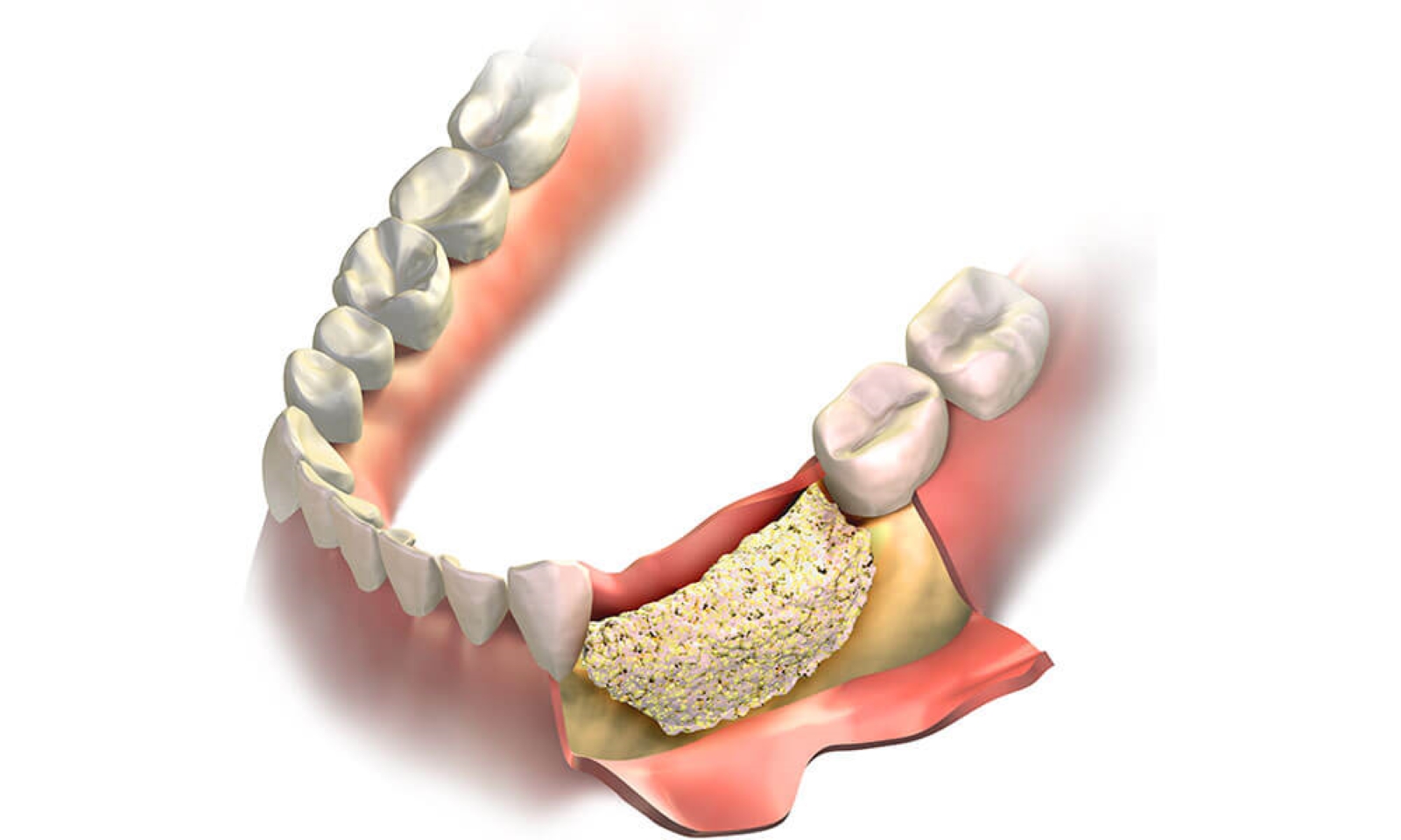 Dental Bone Graft Substitutes Market Growth, Trends, and Forecast 2025-2032