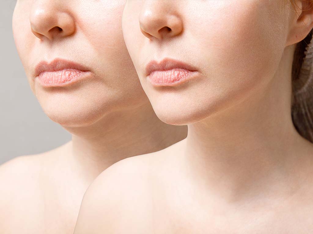 How Can You Minimize Scarring After Facial Plastic Surgery?