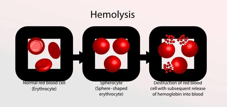 Understanding the Actual Reality of Hemolytic Anemia