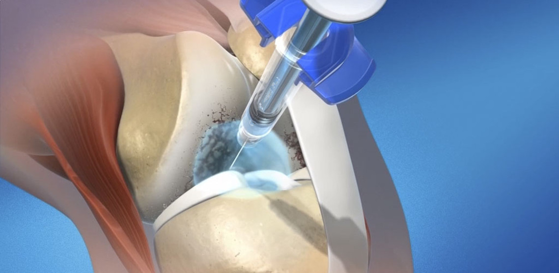 United States of America Viscosupplementation Market to Witness Robust Growth at 8.1% CAGR by 2031 due to Rising Prevalence of Osteoarthritis