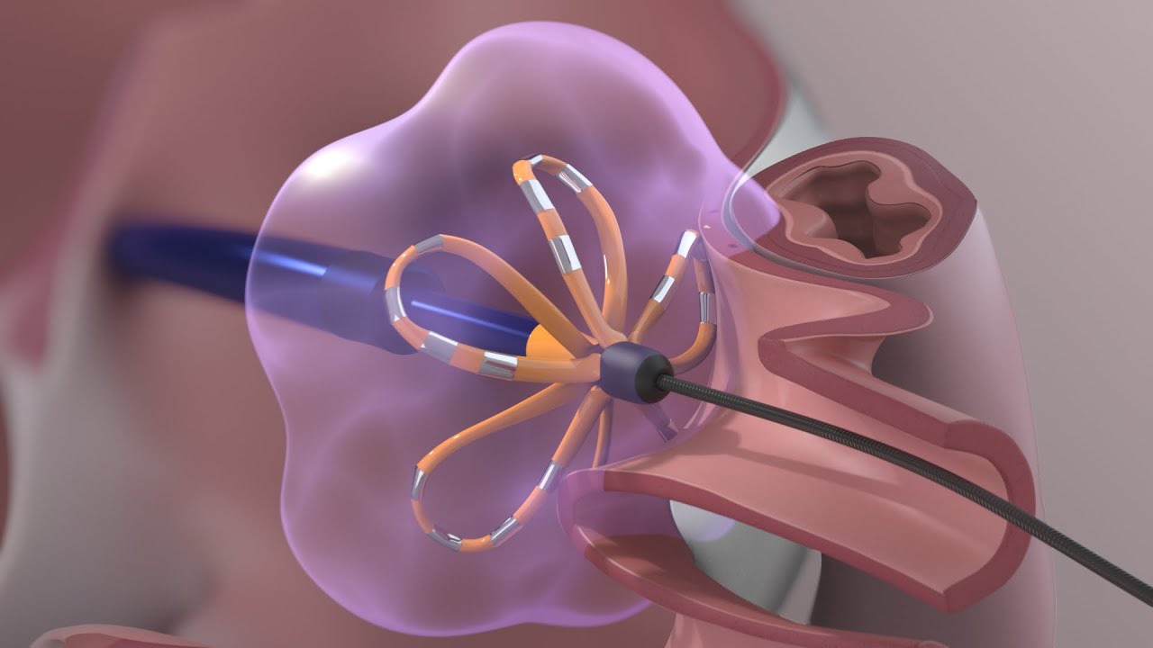 Pulsed Field Ablation Market Set for Rapid Growth due to Rising Prevalence of Cardiac Diseases 