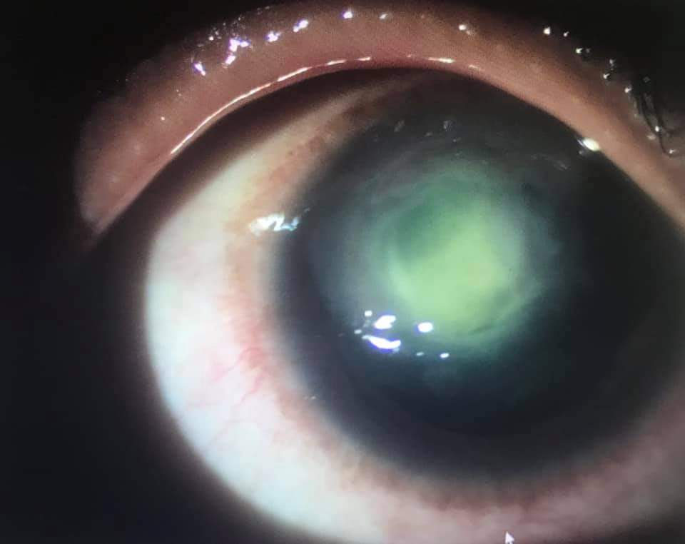 Neurotrophic Keratitis Market is Estimated to Exhibit Robust Growth Due to Advancements in Stem Cell Therapy