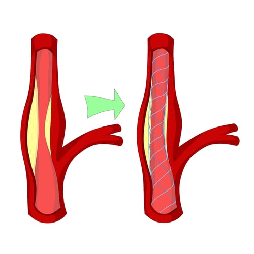 Carotid Artery Stent Market Will Soar with Drug-Eluting Stent Advancements