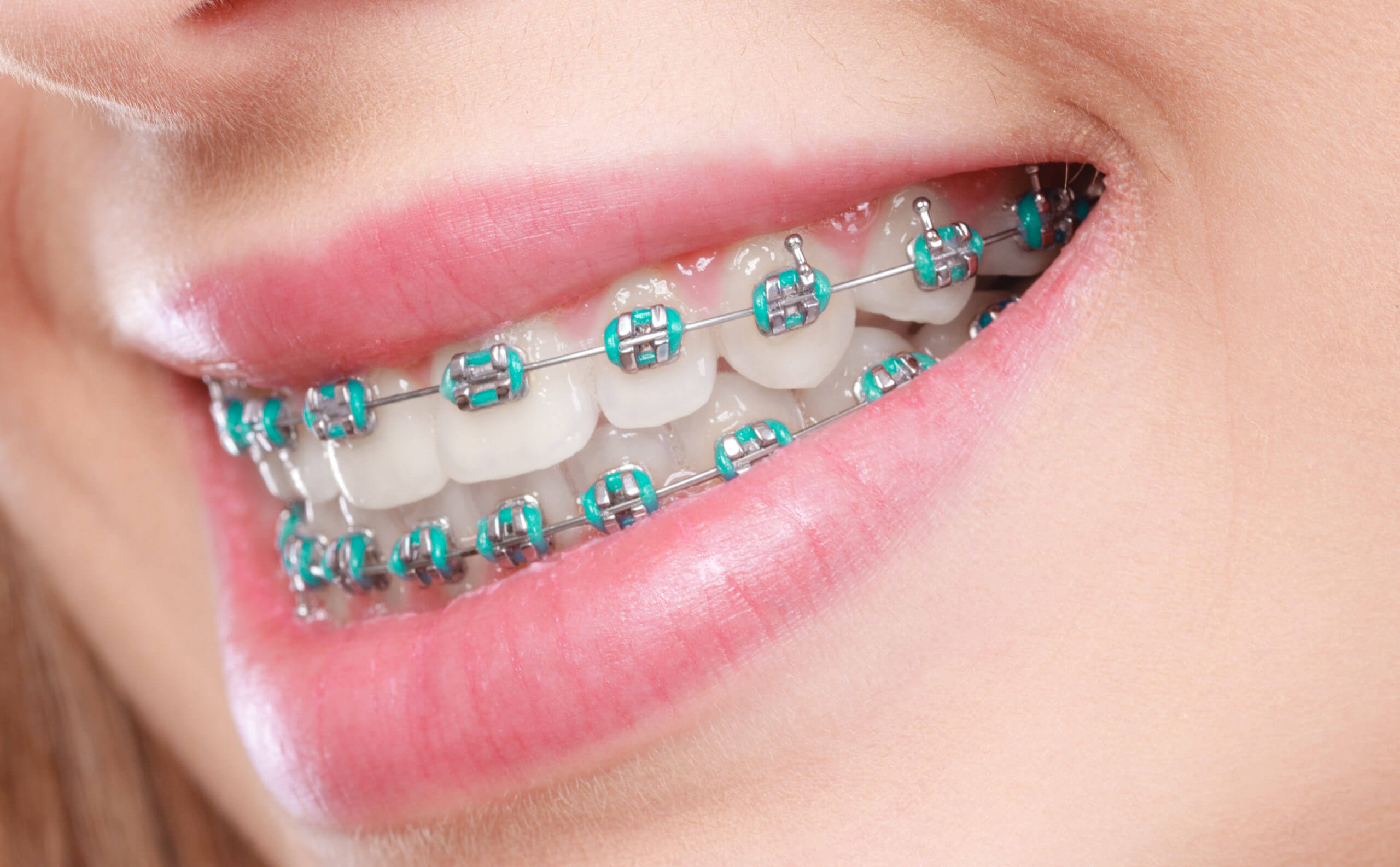 Trusted Orthodontic Treatments for Beautiful Smiles in Peoria and Glendale