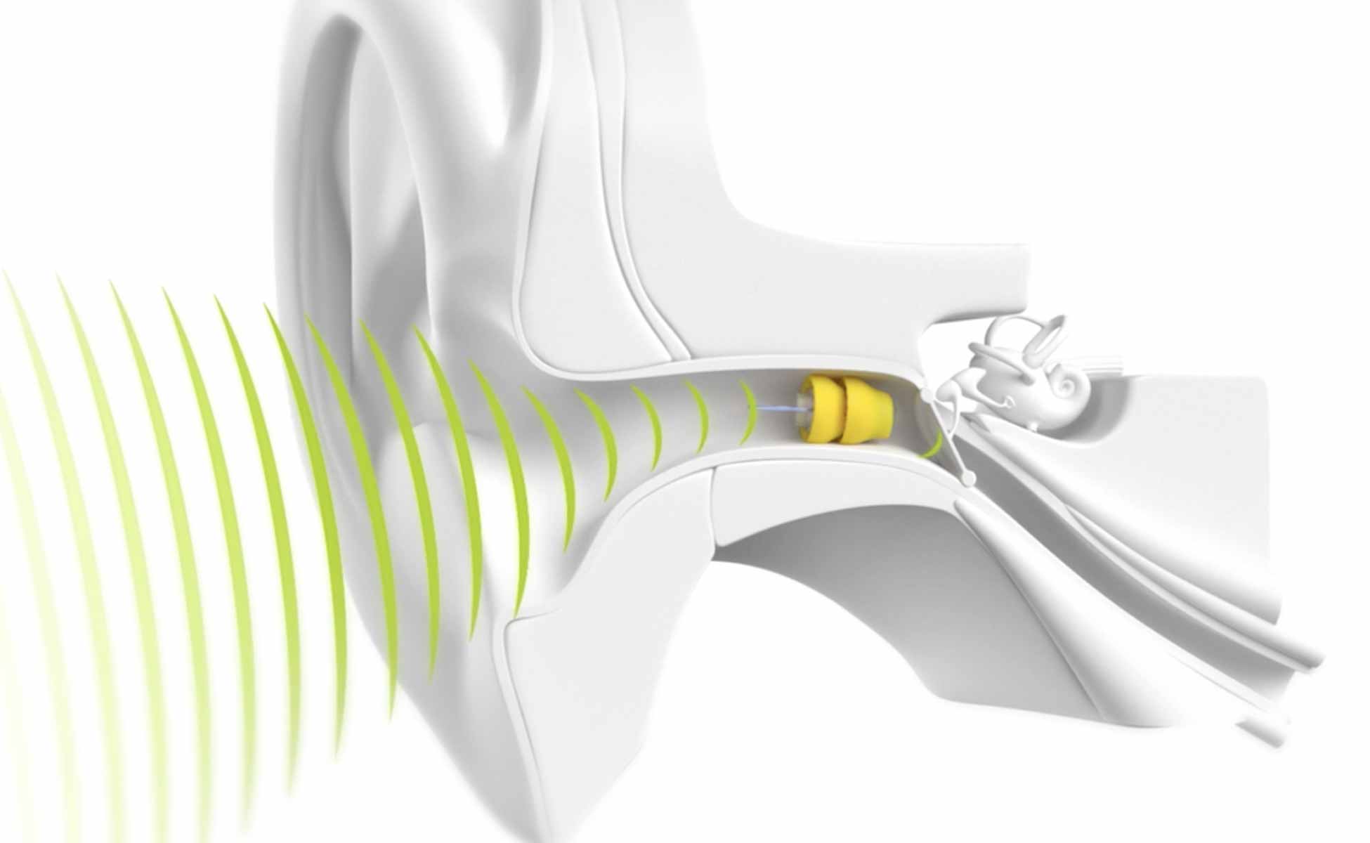 Lyric Hearing Aids: The Invisible Solution for Better Hearing