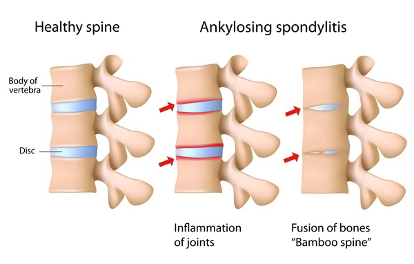 Benefits of Ankylosing Spondylitis Treatment in Homeopathy