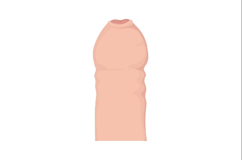 Do Penile Fillers for Girth Enhancement Cause Phimosis in Uncircumcised Men?