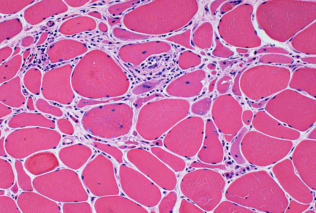 Cervical Intraepithelial Neoplasia Market: Insights and Emerging Therapies