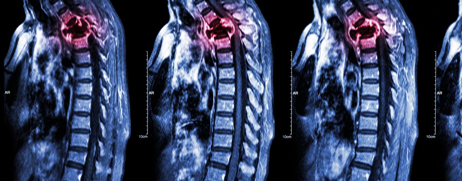 Innovative Therapies Shaping the Bone Metastasis Solid Tumors Market
