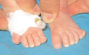 Acrocallosal Syndrome Market will Witness High Growth due to Rising Awareness Regarding Rare Genetic Disorders