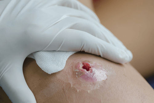 Abscess Treatment Market is to Witness High Growth due to Rising Incidences of Abscess 