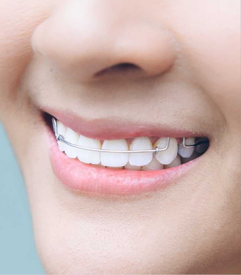 Straighten Your Teeth Effortlessly with Braces and Aligners