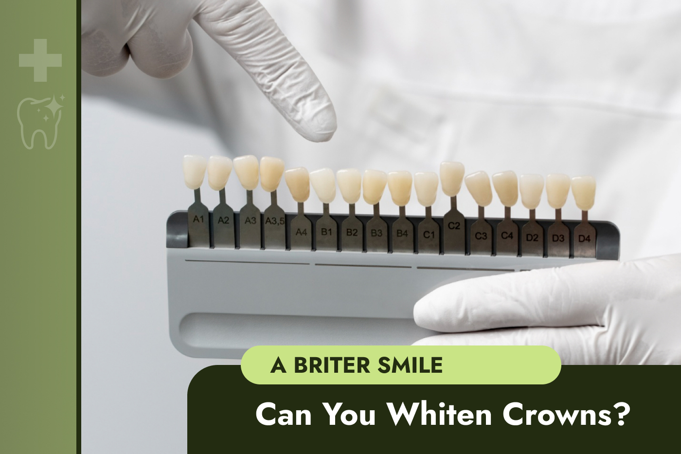 Dental Crown Whitening – Can You Whiten Crowns?