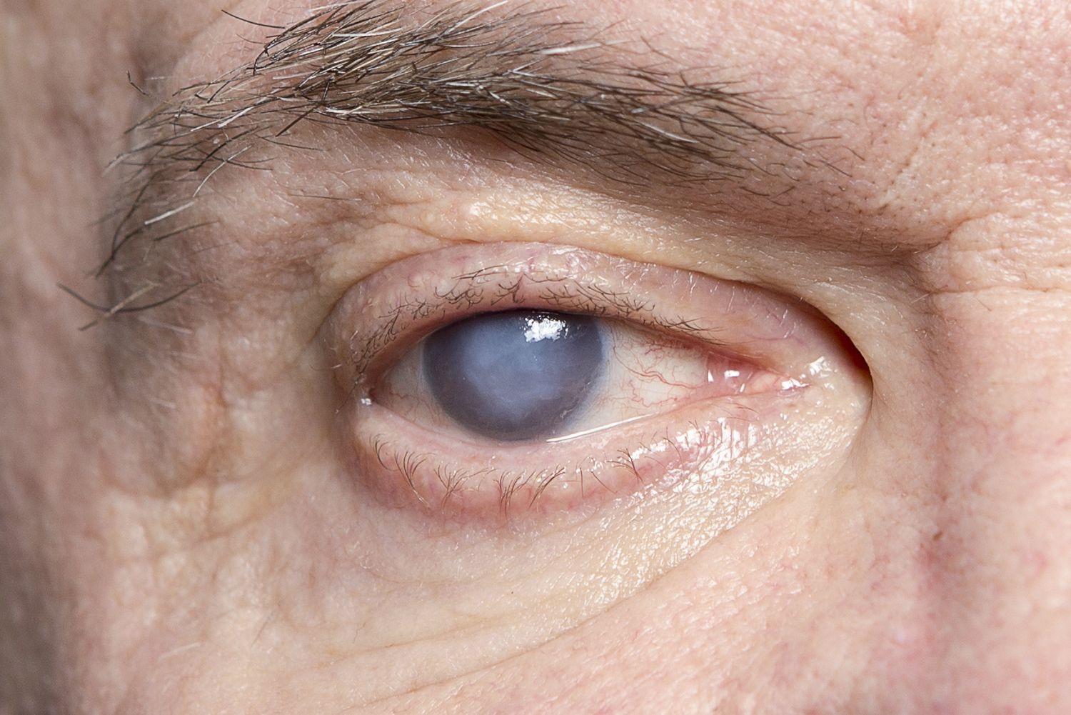 Cataracts (Motiyabind): Types, Causes, Symptoms, and Risk Factors
