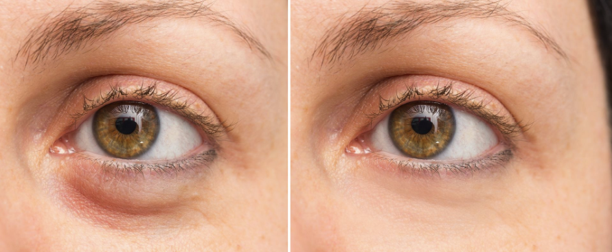 Dark Circle Removal SingaporeDark Circle Removal Singapore