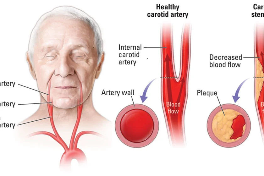 Combatting Carotid Artery Stenosis: Effective Strategies for Prevention and Care